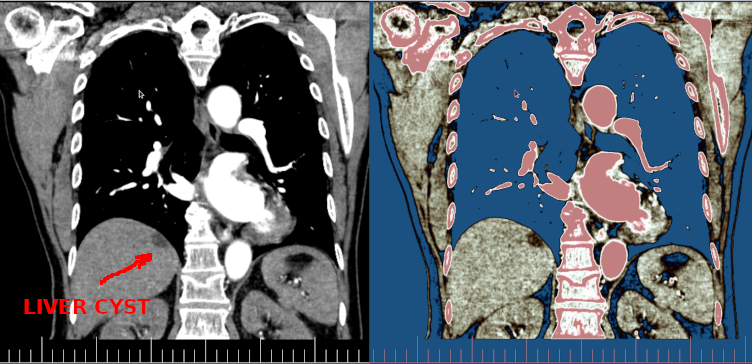 Liver Cyst